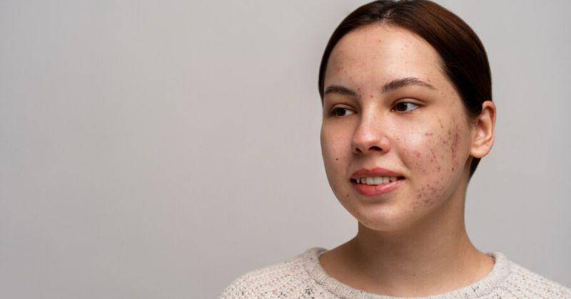 7 Cara Pudarkan Flek Hitam pada Wajah, Pakai Bahan Alami dan Skincare